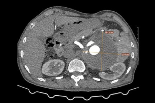 Phát hiện sớm phình động mạch chủ bụng với chụp MSCT